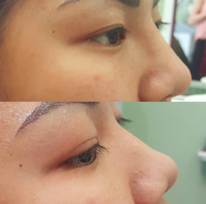 10 Minute Nose job